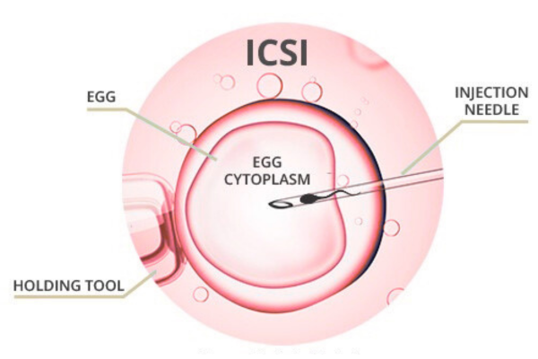 ICSI Procedure in Mumbai